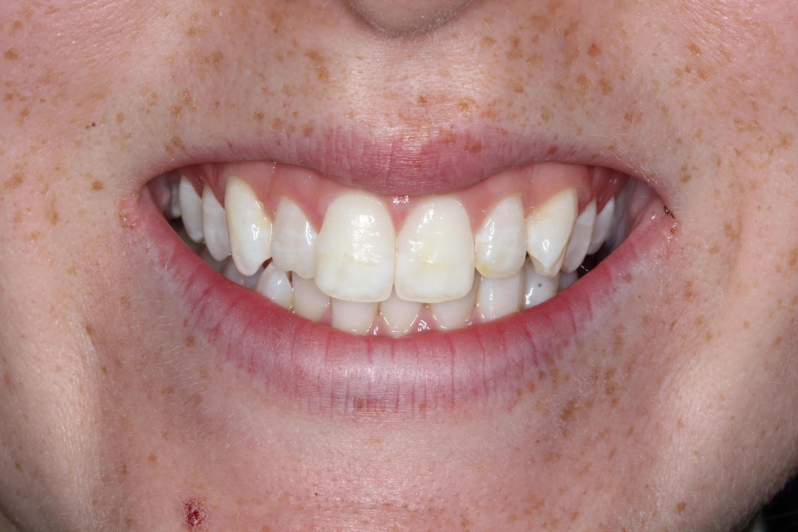 AE Whitening