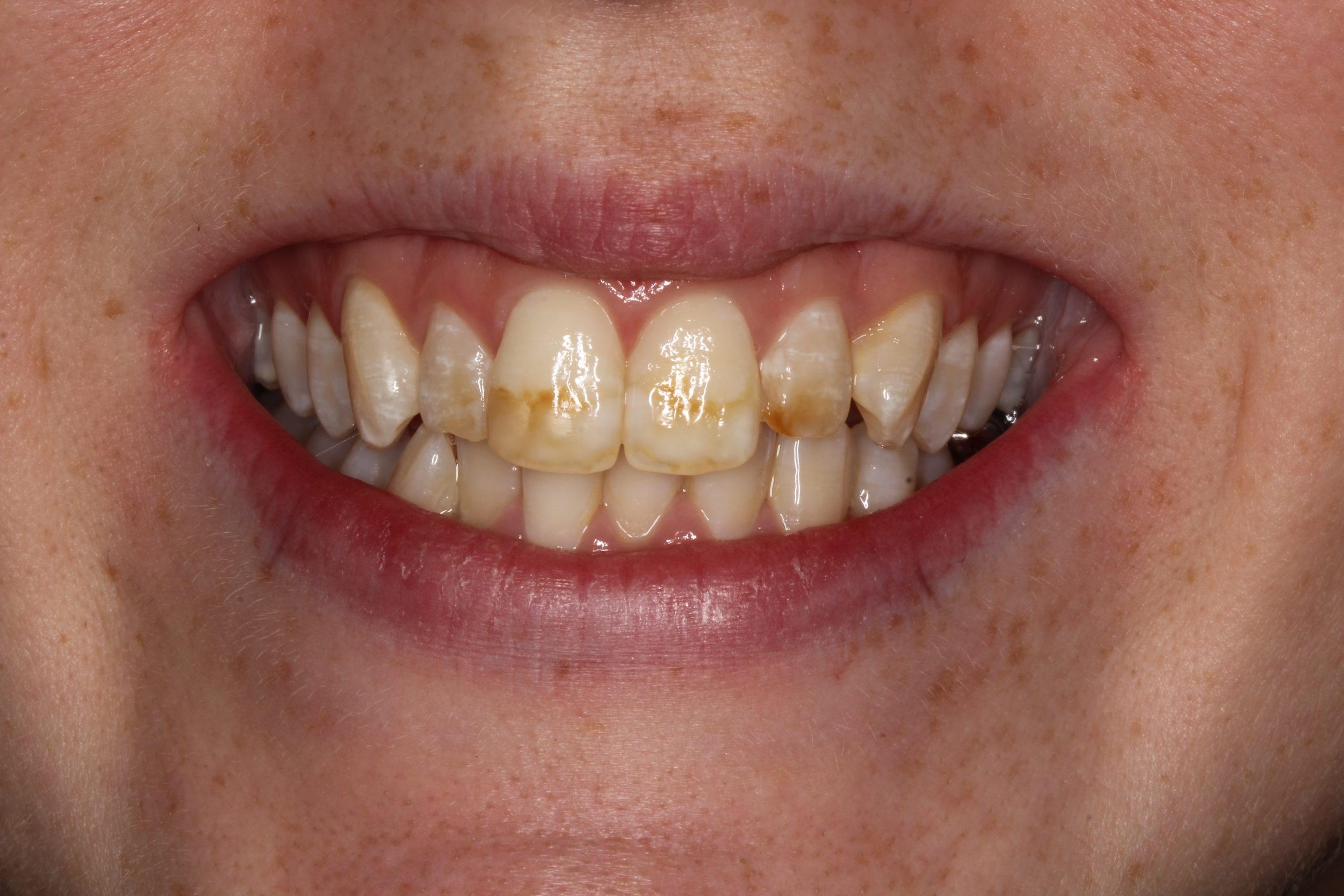 AE prewhitening